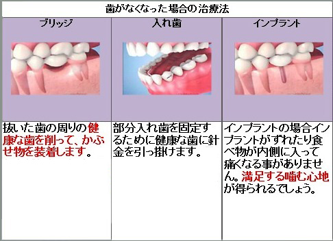 歯がなくなった場合の治療法.jpg