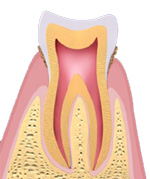 初期歯周病
